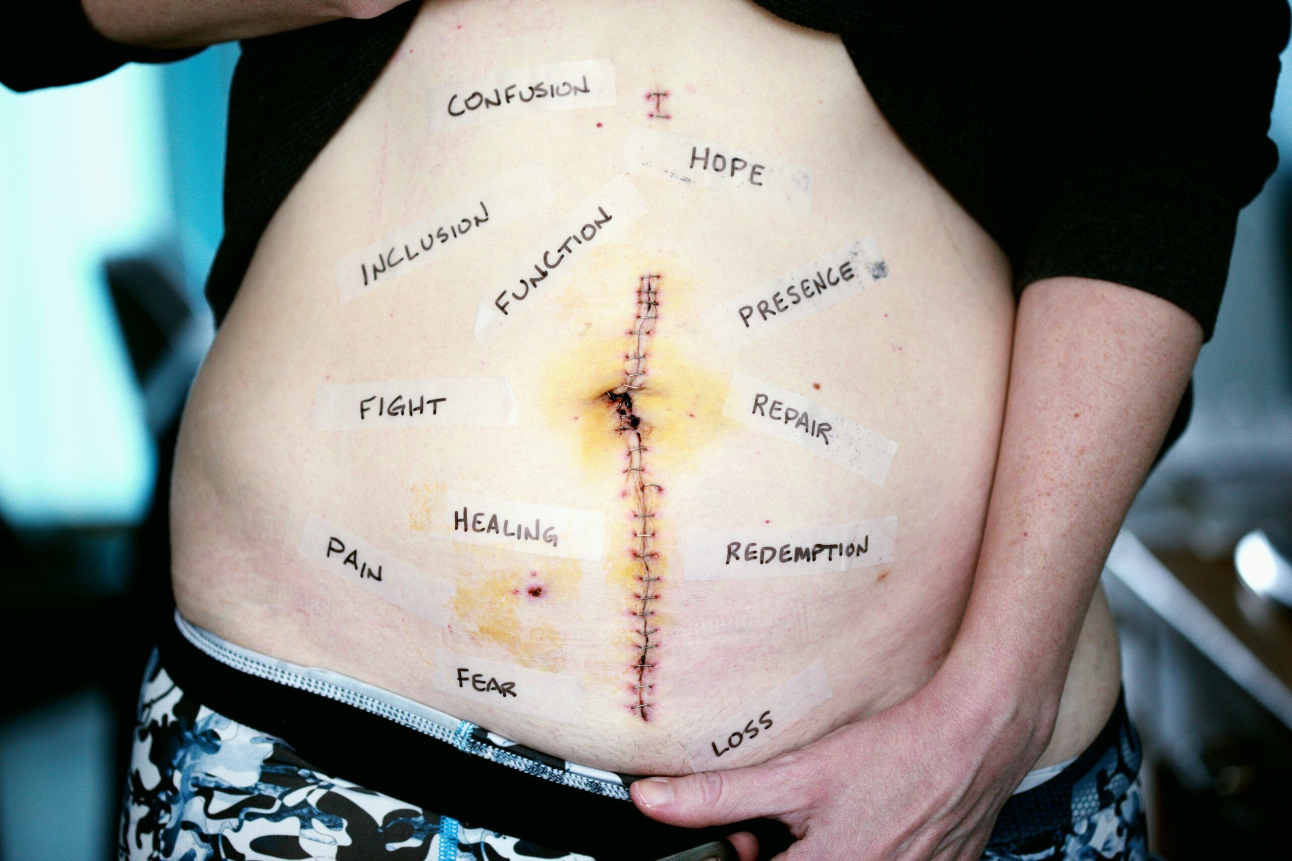 Tratamiento de cicatrices mediante fisioterapia: cuándo y cómo empezar. Fisioterapeutas en Murcia (Llano de Brujas y Guadalupe). Clínica RCB