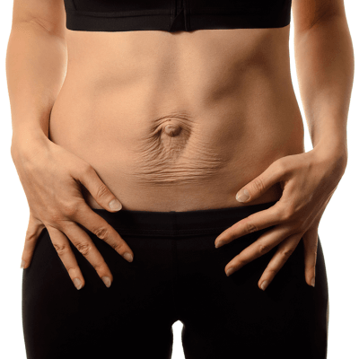 ¿Qué es la diástasis abdominal y cómo se trata con fisioterapia? Fisioterapeutas en Guadalupe y Llano de Brujas (Murcia). Clínica RCB